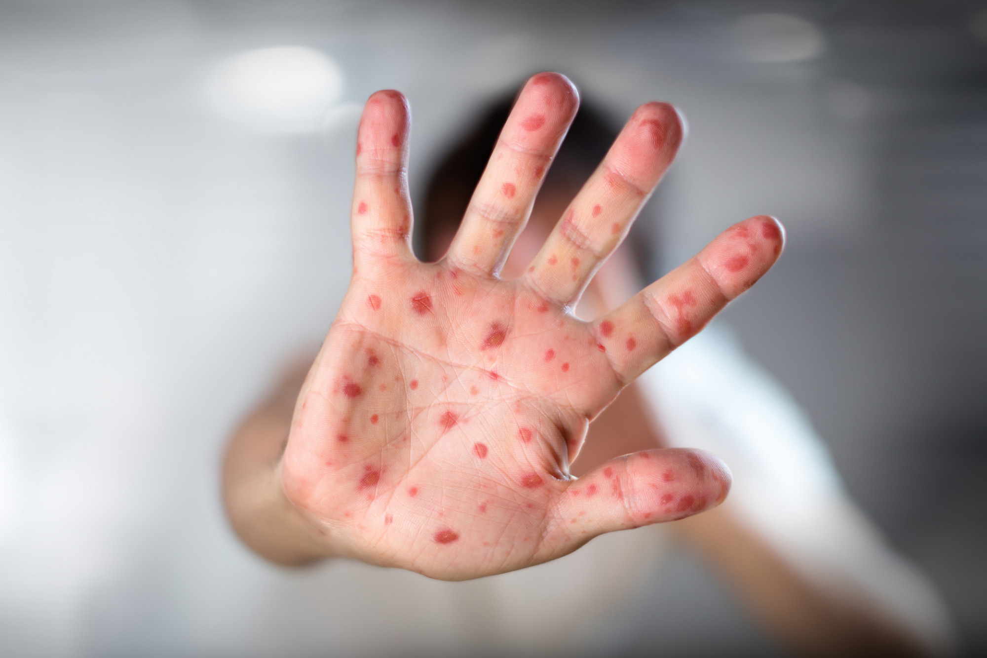 Hand, Foot and Mouth Disease warning for Far North - feature photo