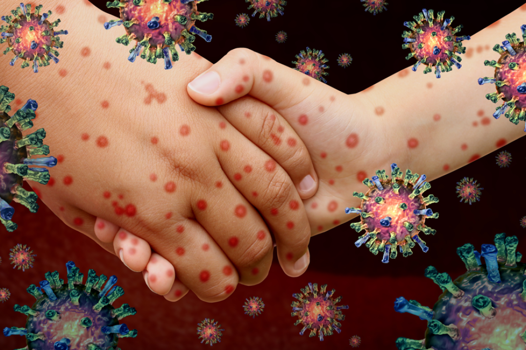 Health alert: measles - feature photo